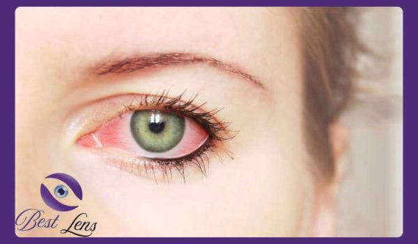 درمان قرمزی چشم ناشی از لنز