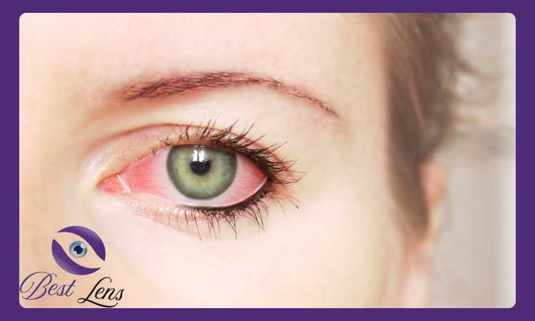 درمان قرمزی چشم ناشی از لنز