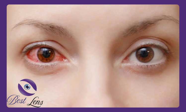  درمان قرمزی چشم ناشی از لنز